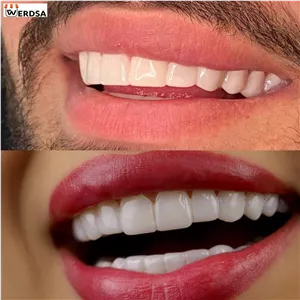 لمینت دندان اصلی آلمانی برای خرابی 4 دندان به همراه عینک دودی ویژه هدیه