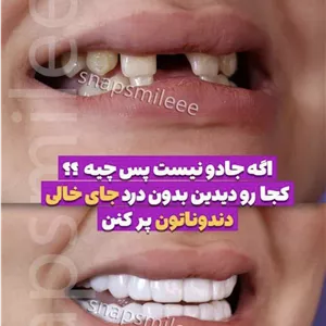 لمینت دندان دو فک اصلی همراه اسباب بازی رایگان جایزه