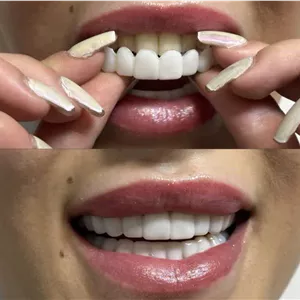 لمینت متحرک دندان دو فک با جایزه 