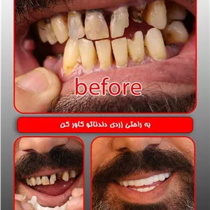 لمینت دندان دو فک اصلی برای خرابی 4 دندان vision 4 دکترفروش
