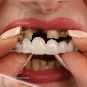 لمینت دندان دو فک اصلی برای خرابی 6 دندان vision6 دکترفروش