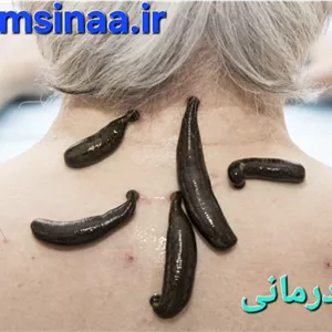 خدمات زالو درمانی با زالوی پرورشی وبهداشتیی وبا وسایل استریل در منزل پذیرفته میشود