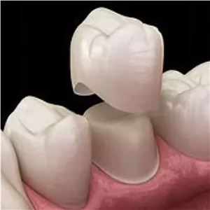 پکیج کامل چسب روکش دندان 4 میل هیوج پرو دائمی