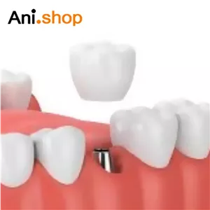 چسب ترکیبی روکش ایمپلنت دندان 4 میل هیوج