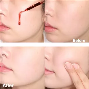 سرم پیلینگ ولایه بردار قوی زامبی بلادی اسکین 1004SKIN1004 Zombie Beauty Bloody Peel – حجم 30 ml