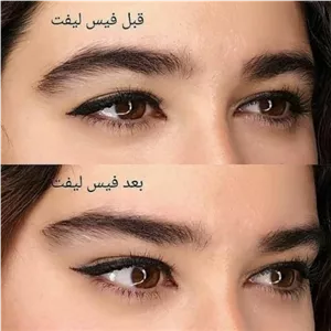 چسب لیفت شقیقه