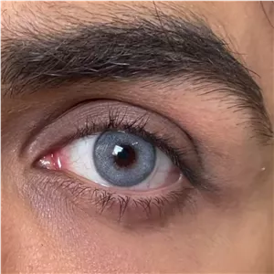 لنز طبی رنگی آبی دهب نچرال بلو