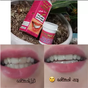 جرم گیر و سفید کننده دندان 
